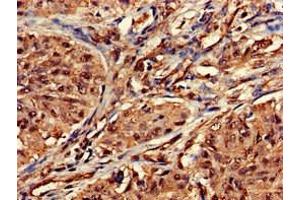 Immunohistochemistry of paraffin-embedded human lung cancer using ABIN7155530 at dilution of 1:100