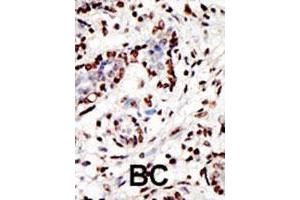 Formalin-fixed and paraffin-embedded human cancer tissue reacted with the MLL polyclonal antibody  , which was peroxidase-conjugated to the secondary antibody, followed by AEC staining. (MLL/KMT2A anticorps  (AA 312-343))