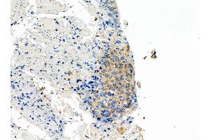 ABIN6258856 and ABIN6275099 at 1/100 staining Human pancreatic cancer by IHC-P. (INSL4 anticorps  (Internal Region))