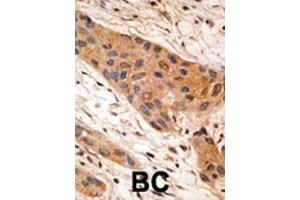 Formalin-fixed and paraffin-embedded human cancer tissue reacted with the primary antibody, which was peroxidase-conjugated to the secondary antibody, followed by AEC staining. (BNIP1 anticorps  (AA 92-127))