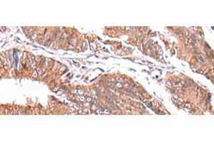 Immunohistochemistry of paraffin-embedded Human colorectal cancer tissue using GATM Polyclonal Antibody at dilution of 1:70(x200) (GATM anticorps)