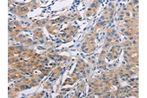 The image on the left is immunohistochemistry of paraffin-embedded Human lung cancer tissue using ABIN7128287(AGBL5 Antibody) at dilution 1/30, on the right is treated with fusion protein. (AGBL5 anticorps)