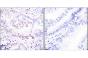 Immunohistochemistry analysis of paraffin-embedded human lung carcinoma, using AML1 (Phospho-Ser303) Antibody.