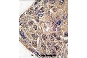 Formalin-fixed and paraffin-embedded human lung carcinoma tissue reacted with YARS antibody (C-term) (ABIN391839 and ABIN2841678) , which was peroxidase-conjugated to the secondary antibody, followed by DAB staining. (YARS anticorps  (C-Term))