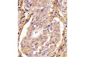 (ABIN659120 and ABIN2843760) staining CD44 in human lung adenocarcinoma tissue sections by Immunohistochemistry (IHC-P - paraformaldehyde-fixed, paraffin-embedded sections). (CD44 anticorps)