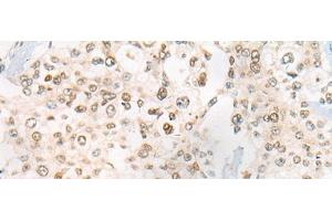 Immunohistochemistry of paraffin-embedded Human prost ate cancer tissue using CEP72 Polyclonal Antibody at dilution of 1:40(x200)