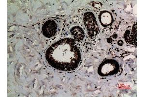 Immunohistochemistry (IHC) analysis of paraffin-embedded Human Breast Cancer, antibody was diluted at 1:100.