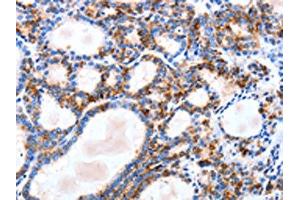 The image on the left is immunohistochemistry of paraffin-embedded Human thyroid cancer tissue using ABIN7129823(IGSF6 Antibody) at dilution 1/10, on the right is treated with fusion protein. (IGSF6 anticorps)