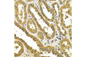 Immunohistochemistry of paraffin-embedded human kidney cancer using μgT1A4 antibody (ABIN5973231) at dilution of 1/200 (40x lens). (UGT1A4 anticorps)