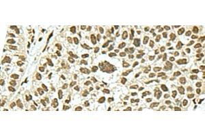 Immunohistochemistry of paraffin-embedded Human esophagus cancer tissue using KHSRP Polyclonal Antibody at dilution of 1:50(x200) (KHSRP anticorps)