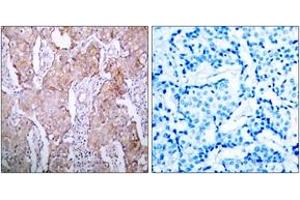 Immunohistochemistry analysis of paraffin-embedded human breast carcinoma, using EGFR (Phospho-Ser1070) Antibody. (EGFR anticorps  (pSer1070))