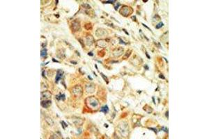 Formalin-fixed and paraffin-embedded human cancer tissue reacted with the primary antibody, which was peroxidase-conjugated to the secondary antibody, followed by DAB staining. (PKC alpha anticorps  (C-Term))