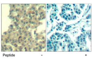 Immunohistochemical analysis of paraffin-embedded human breast carcinoma tissue using ERBB3 polyclonal antibody . (ERBB3 anticorps  (Tyr1328))