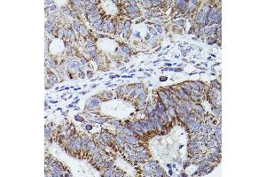 Immunohistochemistry of paraffin-embedded human colon carcinoma using THBS1 Rabbit pAb (ABIN3022978, ABIN3022979, ABIN3022980 and ABIN6219329) at dilution of 1:50 (40x lens).
