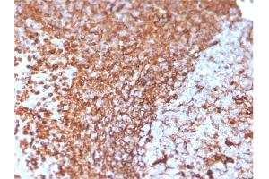 Formalin-fixed, paraffin-embedded human Prostate Carcinoma stained with Vimentin Mouse Monoclonal Antibody (VIM/3736).