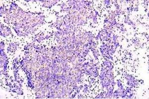 Immunohistochemistry (IHC) analysis of PRKAA1 antibody in paraffin-embedded human lung adenocarcinoma tissue. (PRKAA1 anticorps)