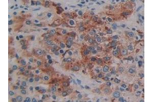 Detection of NPY in Human Prostate cancer Tissue using Polyclonal Antibody to Neuropeptide Y (NPY)