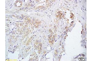 Formalin-fixed and paraffin embedded human cervical carcinoma labeled with Anti FUT8 Polyclonal Antibody, Unconjugated (ABIN716801) at 1:200 followed by conjugation to the secondary antibody and DAB staining (FUT8 anticorps  (AA 311-410))