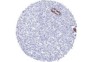 Absence of E cadherin staining in an invasive lobular breast cancer while normal breast glands show strong E cadherin positivity