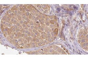ABIN6272659 at 1/100 staining Human Melanoma tissue by IHC-P. (MFGE8 anticorps  (C-Term))