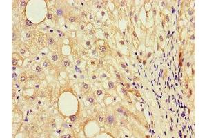 Immunohistochemistry of paraffin-embedded human liver cancer using ABIN7156880 at dilution of 1:100 (EBI3 anticorps  (AA 21-227))