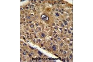 Formalin-fixed and paraffin-embedded human hepatocarcinoma reacted with TOB1 Antibody (N-term), which was peroxidase-conjugated to the secondary antibody, followed by DAB staining.