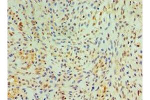 Immunohistochemistry of paraffin-embedded human breast cancer using ABIN7149005 at dilution of 1:100