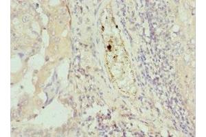 Immunohistochemistry of paraffin-embedded human lung cancer using ABIN7172749 at dilution of 1:100 (Protein C8orf4 (TCIM) (AA 1-106) anticorps)