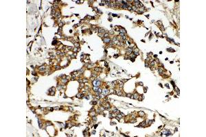 Anti-HNF6 antibody, IHC(P) IHC(P): Human Liver Cancer Tissue (ONECUT1 anticorps  (N-Term))