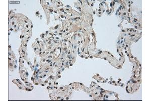 Immunohistochemical staining of paraffin-embedded Adenocarcinoma of breast tissue using anti-NTRK3 mouse monoclonal antibody. (NTRK3 anticorps)