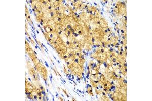 Immunohistochemistry of paraffin-embedded human lung cancer using CAPG Antibody. (CAPG anticorps  (AA 1-348))