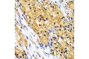 Immunohistochemistry of paraffin-embedded human lung cancer using CAPG Antibody. (CAPG anticorps  (AA 1-348))