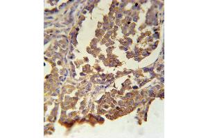 MC2R Antibody immunohistochemistry analysis in formalin fixed and paraffin embedded human skin carcinoma followed by peroxidase conjugation of the secondary antibody and DAB staining. (MC5 Receptor anticorps  (C-Term))