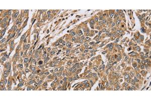 Immunohistochemistry of paraffin-embedded Human lung cancer using PTGER2 Polyclonal Antibody at dilution of 1:45 (PTGER2 anticorps)