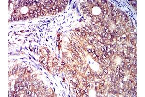 Immunohistochemical analysis of paraffin-embedded cervical cancer tissues using CD158E1 mouse mAb with DAB staining. (KIR3DL1 anticorps  (AA 206-340))