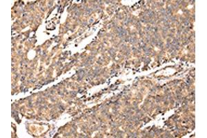 The image on the left is immunohistochemistry of paraffin-embedded Human prostate cancer tissue using ABIN7128064(UGGT2 Antibody) at dilution 1/20, on the right is treated with fusion protein. (UGCGL2 anticorps)