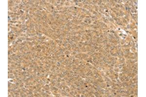 The image on the left is immunohistochemistry of paraffin-embedded Human ovarian cancer tissue using ABIN7192889(TRIM22 Antibody) at dilution 1/25, on the right is treated with synthetic peptide. (TRIM22 anticorps)
