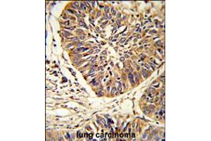 Formalin-fixed and paraffin-embedded human lung carcinoma reacted with PDIA3 Antibody , which was peroxidase-conjugated to the secondary antibody, followed by DAB staining. (PDIA3 anticorps  (C-Term))