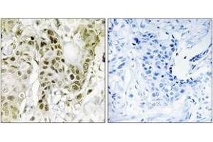 Immunohistochemistry analysis of paraffin-embedded human breast carcinoma tissue, using BCOR Antibody.
