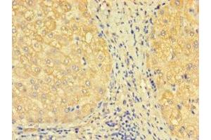 Immunohistochemistry of paraffin-embedded human liver tissue using ABIN7171277 at dilution of 1:100 (SDCBP2 anticorps  (AA 11-207))