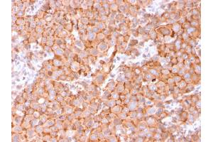 Formalin-fixed, paraffin-embedded human Urothelial Carcinoma stained with Uroplakin 1B Mouse Monoclonal Antibody (UPK1B/3081). (Uroplakin 1B anticorps  (AA 109-229))