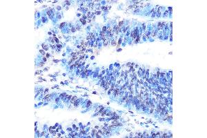 Immunohistochemistry of paraffin-embedded human colon carcinoma using PTBP1 Rabbit mAb (ABIN7269464) at dilution of 1:100 (40x lens).