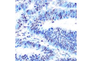 Immunohistochemistry of paraffin-embedded human colon carcinoma using PTBP1 Rabbit mAb (ABIN7269464) at dilution of 1:100 (40x lens). (PTBP1 anticorps)