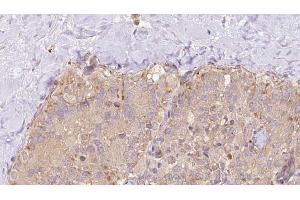 ABIN6273327 at 1/100 staining Human thyroid cancer tissue by IHC-P. (Syntaxin 17 anticorps  (C-Term))