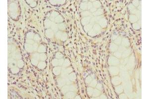 Immunohistochemistry of paraffin-embedded human colon cancer using ABIN7145307 at dilution of 1:100 (BCL2-Like 15 anticorps  (AA 1-163))