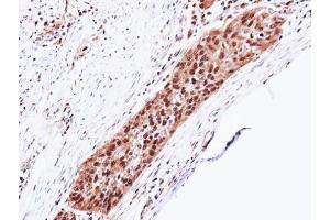 IHC-P Image Immunohistochemical analysis of paraffin-embedded H1299 xenograft, using Proteasome 20S alpha 5, antibody at 1:100 dilution. (PSMA5 anticorps  (Center))