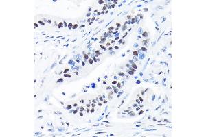 Immunohistochemistry of paraffin-embedded human colon carcinoma using SUPT5H/SPT5 Rabbit mAb (ABIN7270878) at dilution of 1:100 (40x lens). (SUPT5H anticorps)