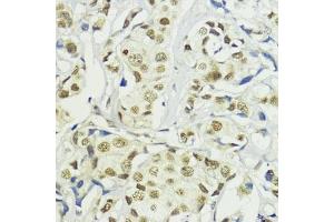 Immunohistochemistry of paraffin-embedded human mammary cancer using BA antibody (ABIN7265937) at dilution of 1:200 (40x lens). (BAZ2A anticorps)