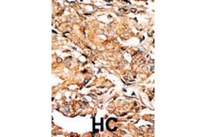 Formalin-fixed and paraffin-embedded human cancer tissue reacted with the primary antibody, which was peroxidase-conjugated to the secondary antibody, followed by AEC staining.