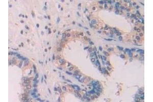 Detection of Ab1-42 in Human Prostate Tissue using Monoclonal Antibody to Amyloid Beta Peptide 1-42 (Ab1-42)